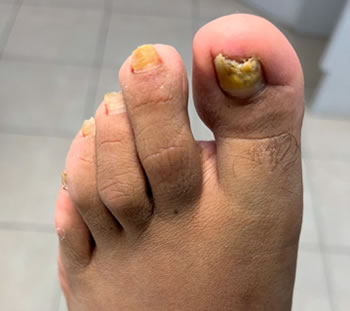 Hongos en uña o pie